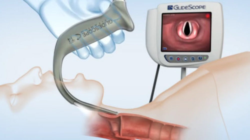 GlideScope intubation illustration