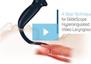 4-step-technique-glidescope-intubation